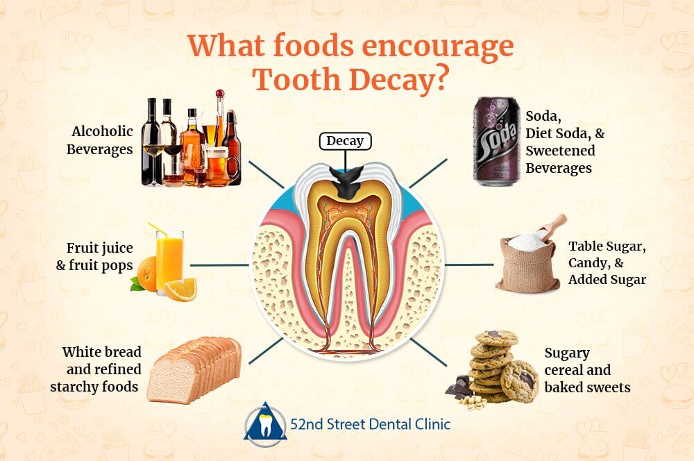 Which Food Encourages Tooth Decay?